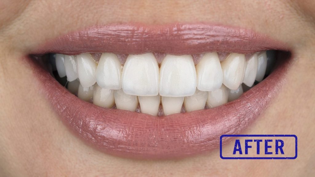 名古屋でラミネートベニアをお考えの方へ｜自然な仕上がりの審美歯科